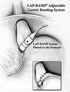 Lap-Band